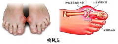 痛风典型的发作部位是大脚趾 成都治疗痛风哪里更好