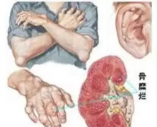 自行挤压痛风石当心感染、创口难愈合 成都专业治疗痛