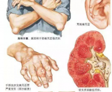 痛风石是痛风不及时治疗拖出来的吗？成都治疗痛风专业