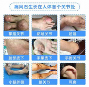 成都痛风科普中心：发病初期痛风会产生痛风石吗?