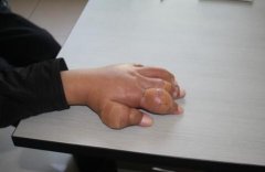 痛风常识科普：痛风石通常长在哪些部位？