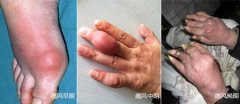 痛风性关节炎并发症有哪些