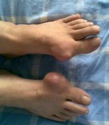 成都痛风治疗医院哪家好？痛风症状检查有哪些？
