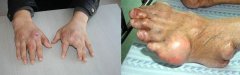 痛风性关节炎有哪些临床表现？
