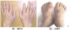  高尿酸血症期：痛风专业阶段 