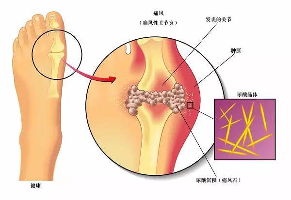 成都西部痛风风湿医院