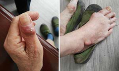 假性痛风是怎么回事?